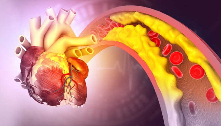 Illustrasjonen viser et hjerte med delvis blokkert arterie